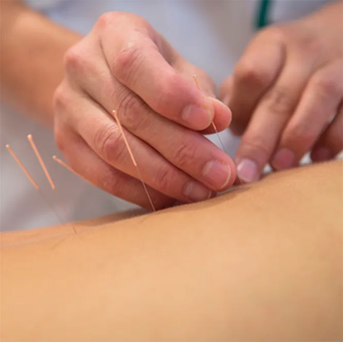 Fine acupuncture needles being placed in a patient’s back